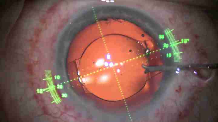 Лечение и операция по удалению катаракты